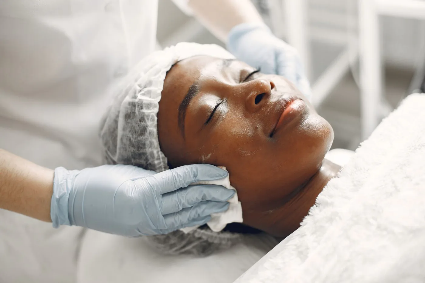 Chemical Peels